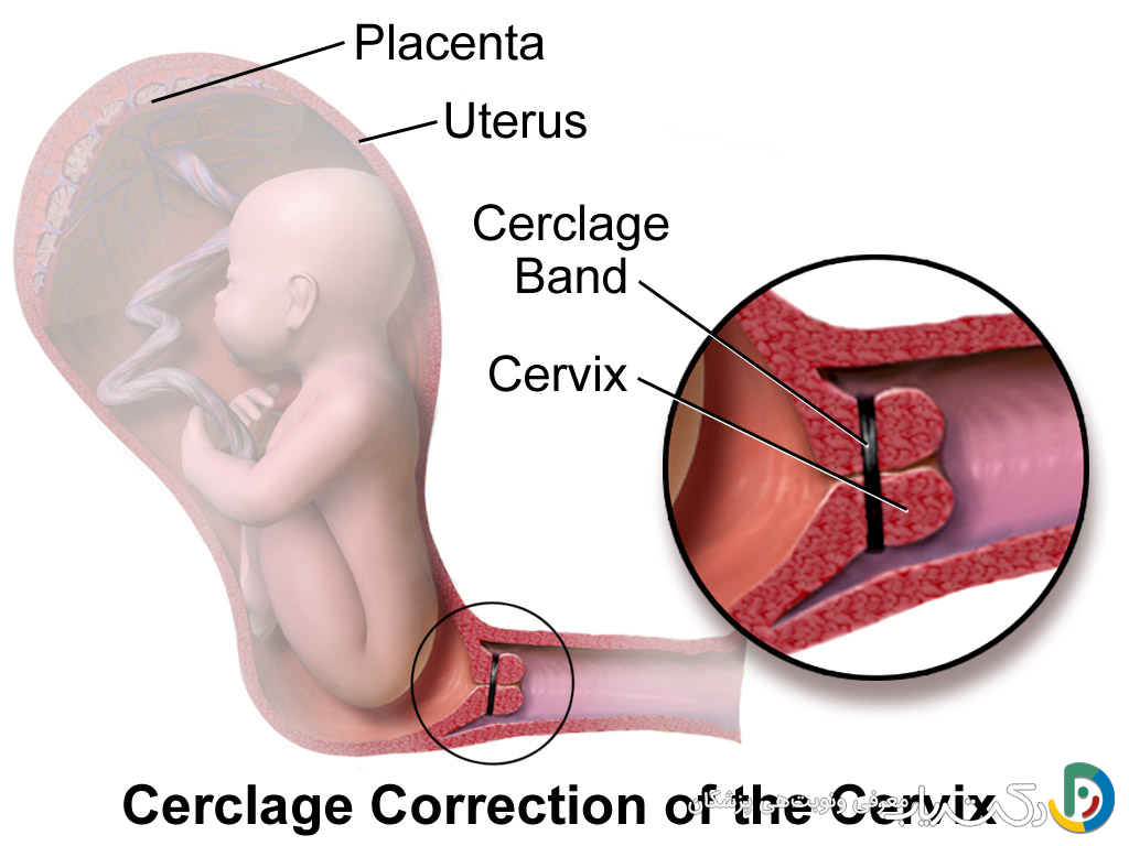 آیا عمل سرکلاژ درد دارد؟
