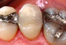برای پر کردن دندان، کامپوزیت بهتر است یا آمالگام؟