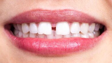 برای بستن فاصله دندان کامپوزیت بهتر است یا ارتودنسی؟