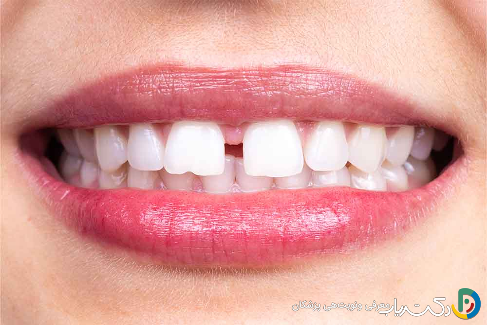 برای بستن فاصله دندان کامپوزیت بهتر است یا ارتودنسی؟