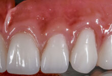 آیا کامپوزیت قابل برداشتن ریموو است؟