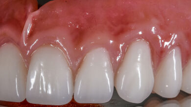 آیا کامپوزیت قابل برداشتن ریموو است؟