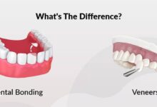 باندینگ دندان همان کامپوزیت است؟