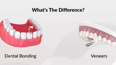 باندینگ دندان همان کامپوزیت است؟