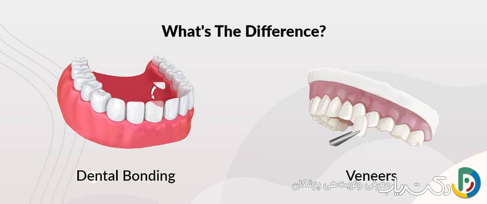 باندینگ دندان همان کامپوزیت است؟