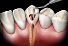 آیا ممکن است به عصب دندان هنگام ترمیم آسیب برسد؟