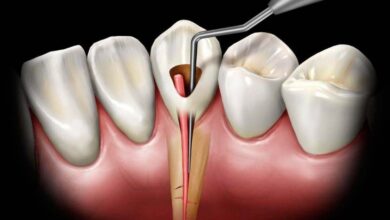 آیا ممکن است به عصب دندان هنگام ترمیم آسیب برسد؟