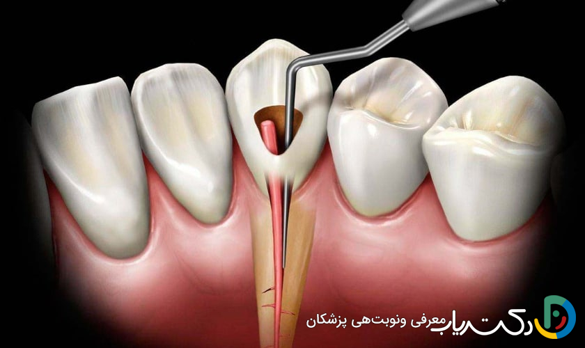 آیا ممکن است به عصب دندان هنگام ترمیم آسیب برسد؟