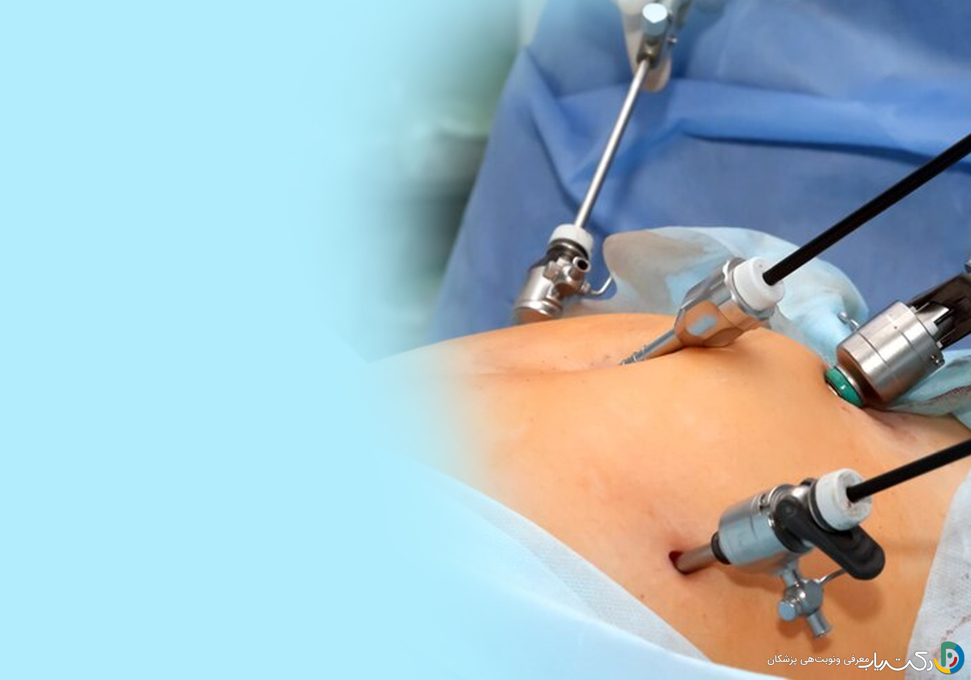 آیا عمل لاپاراسکوپی درد دارد؟