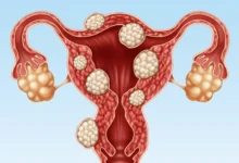 آیا عمل میومکتومی دردناک است؟