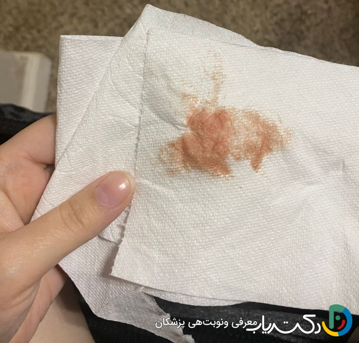 لکه بینی و خونریزی خفیف بعد از سرکلاژ طبیعی است؟