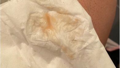 آیا ترشحات واژن بعد از سرکلاژ طبیعی است؟