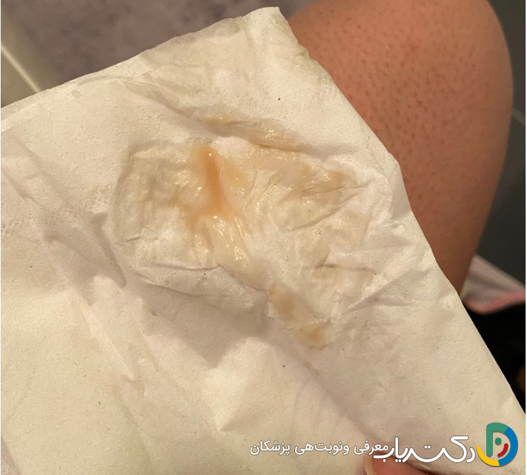 آیا ترشحات واژن بعد از سرکلاژ طبیعی است؟