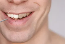 آیا سفید کردن دندان با سرکه سیب موثر است؟