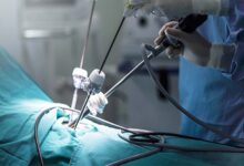 لاپاراسکوپی چیست؟ عمل لاپاراسکوپی چگونه انجام میشود؟