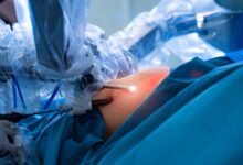 آیا احتمال تبدیل عمل لاپاراسکوپی به عمل باز وجود دارد؟