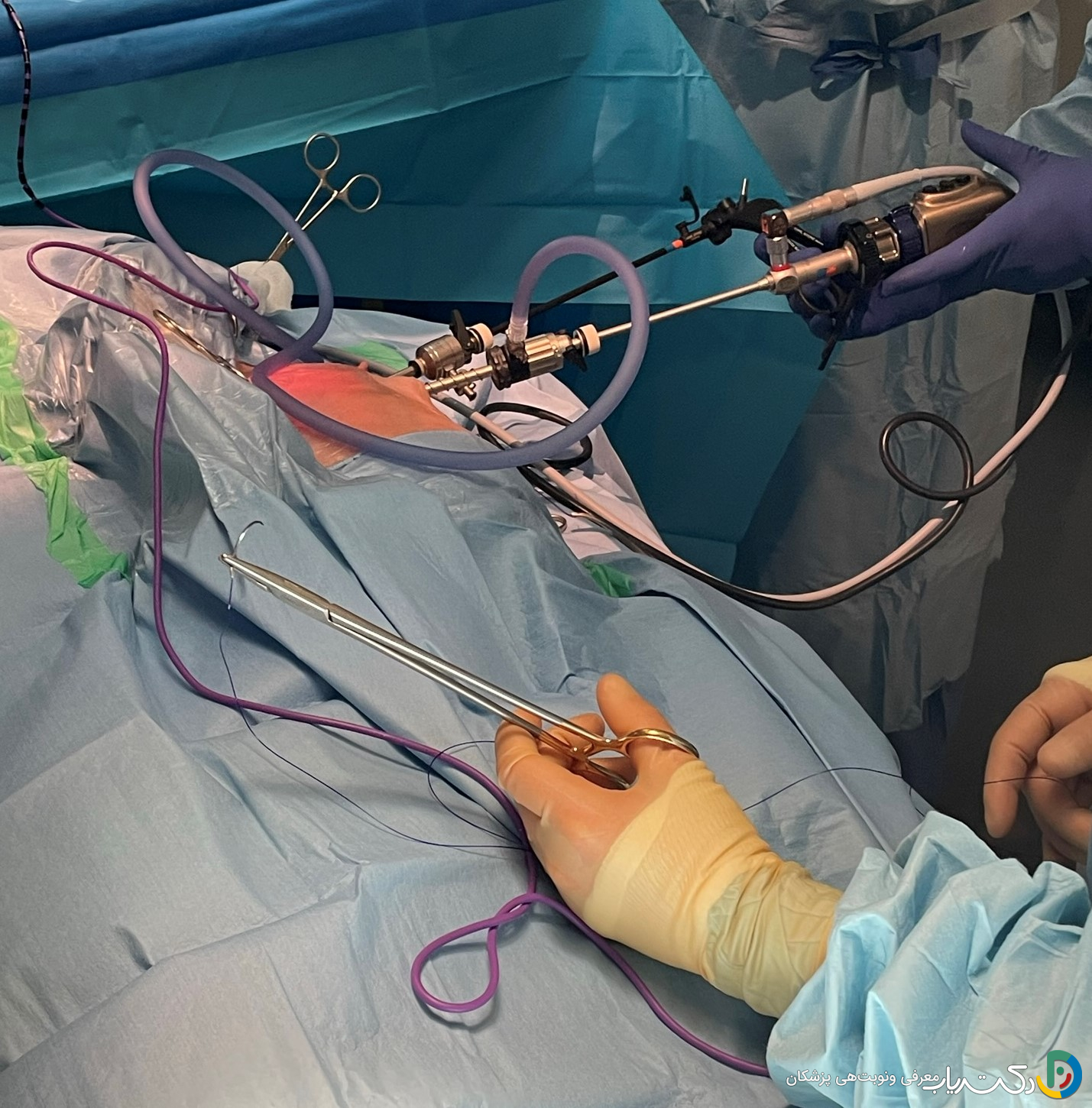 بهترین پماد برای جای زخم لاپاراسکوپی چیست؟