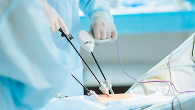 لاپاراسکوپی کیست تخمدان چگونه است؟