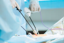 چه زمانی بخیههای لاپاراسکوپی کشیده یا جذب میشوند؟