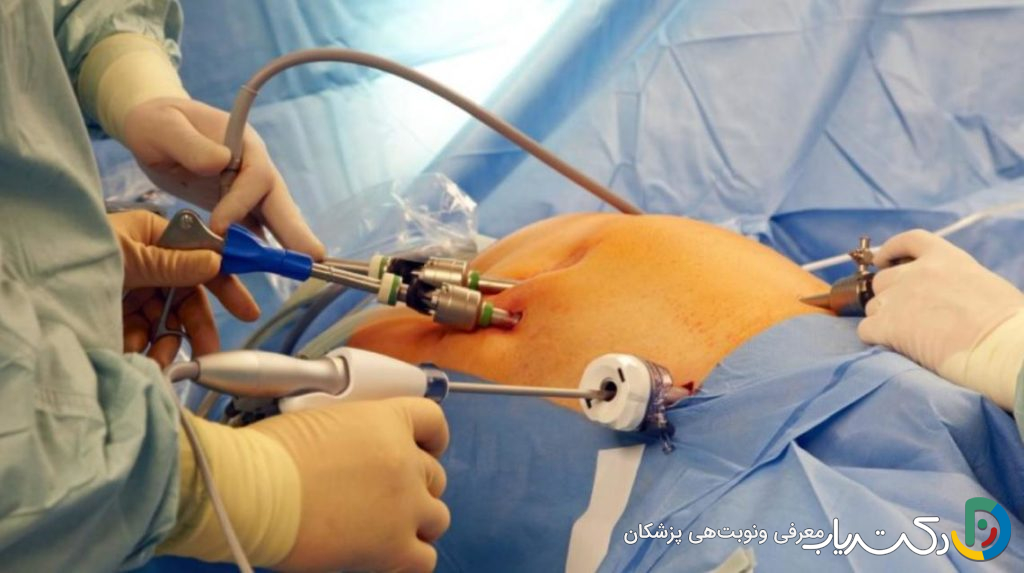 آیا چاقی مانعی برای انجام لاپاراسکوپی است؟