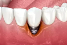 پری ایمپلنتایتیس Peri implantitis چیست و چگونه درمان می شود؟