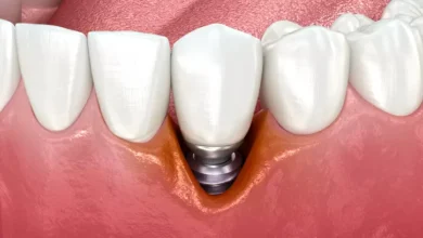 پری ایمپلنتایتیس Peri implantitis چیست و چگونه درمان می شود؟