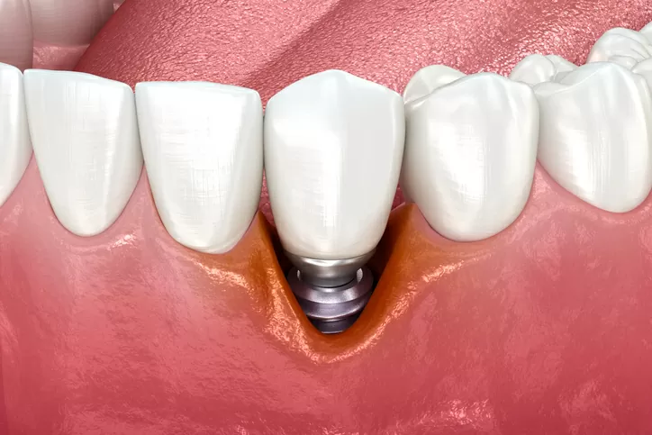 پری ایمپلنتایتیس Peri implantitis چیست و چگونه درمان می شود؟