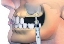 سینوس لیفت (جراحی بالا بردن سینوس) چیست و چرا انجام می شود؟