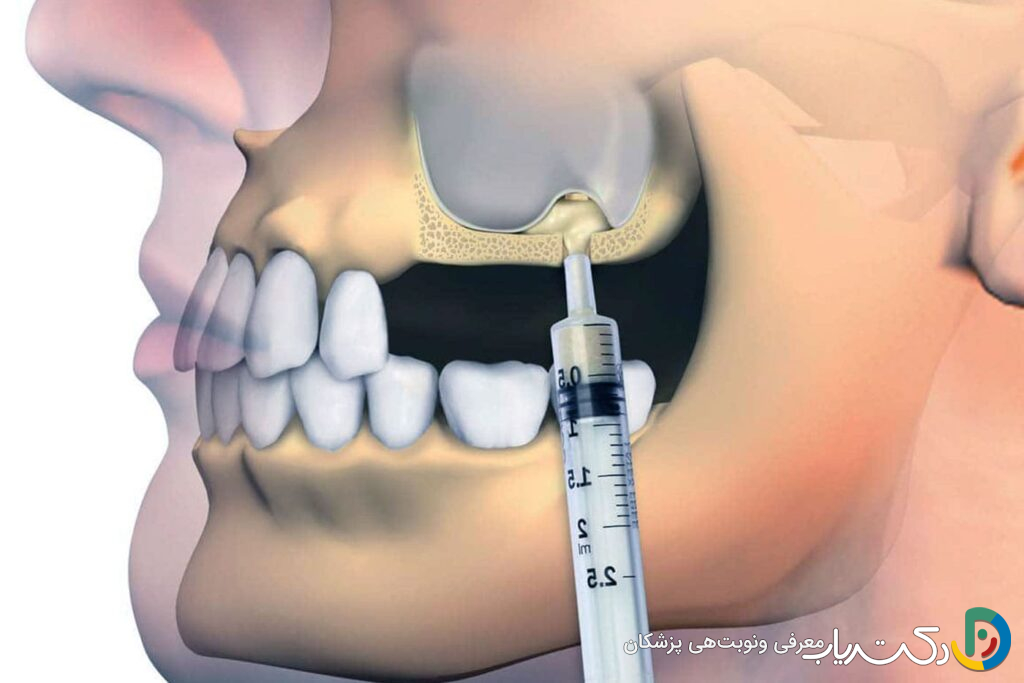 سینوس لیفت (جراحی بالا بردن سینوس) چیست و چرا انجام می شود؟