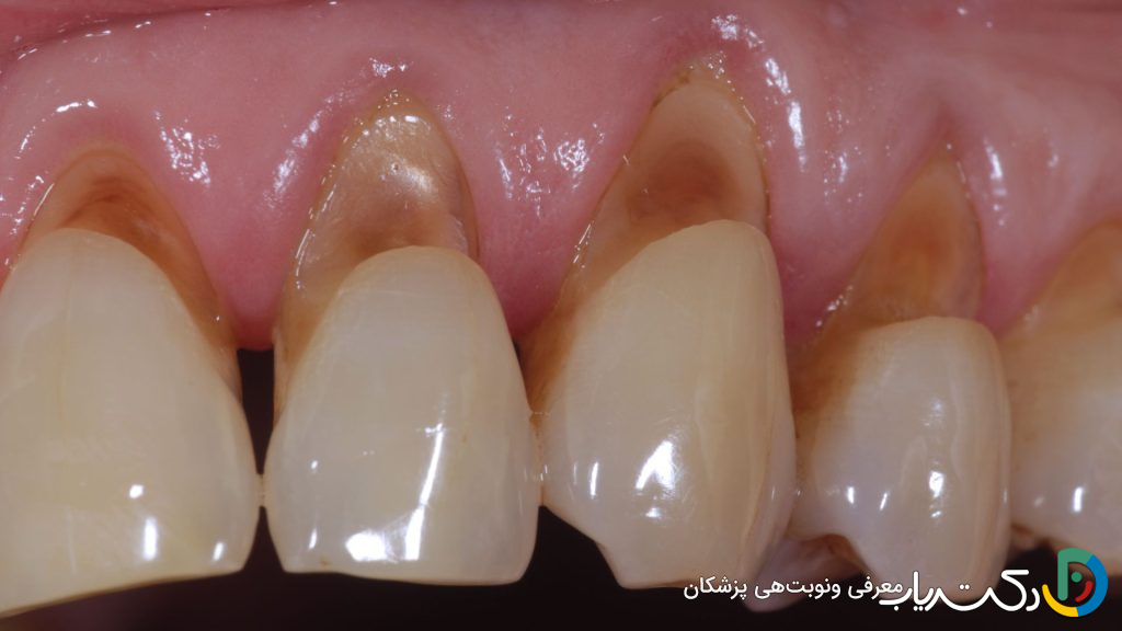 علائم پوسیدگی زیر کامپوزیت