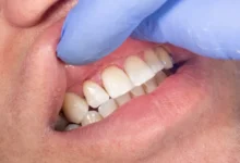 چگونه از پوسیدگی دندان زیر روکش جلوگیری کنیم؟