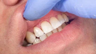 چگونه از پوسیدگی دندان زیر روکش جلوگیری کنیم؟