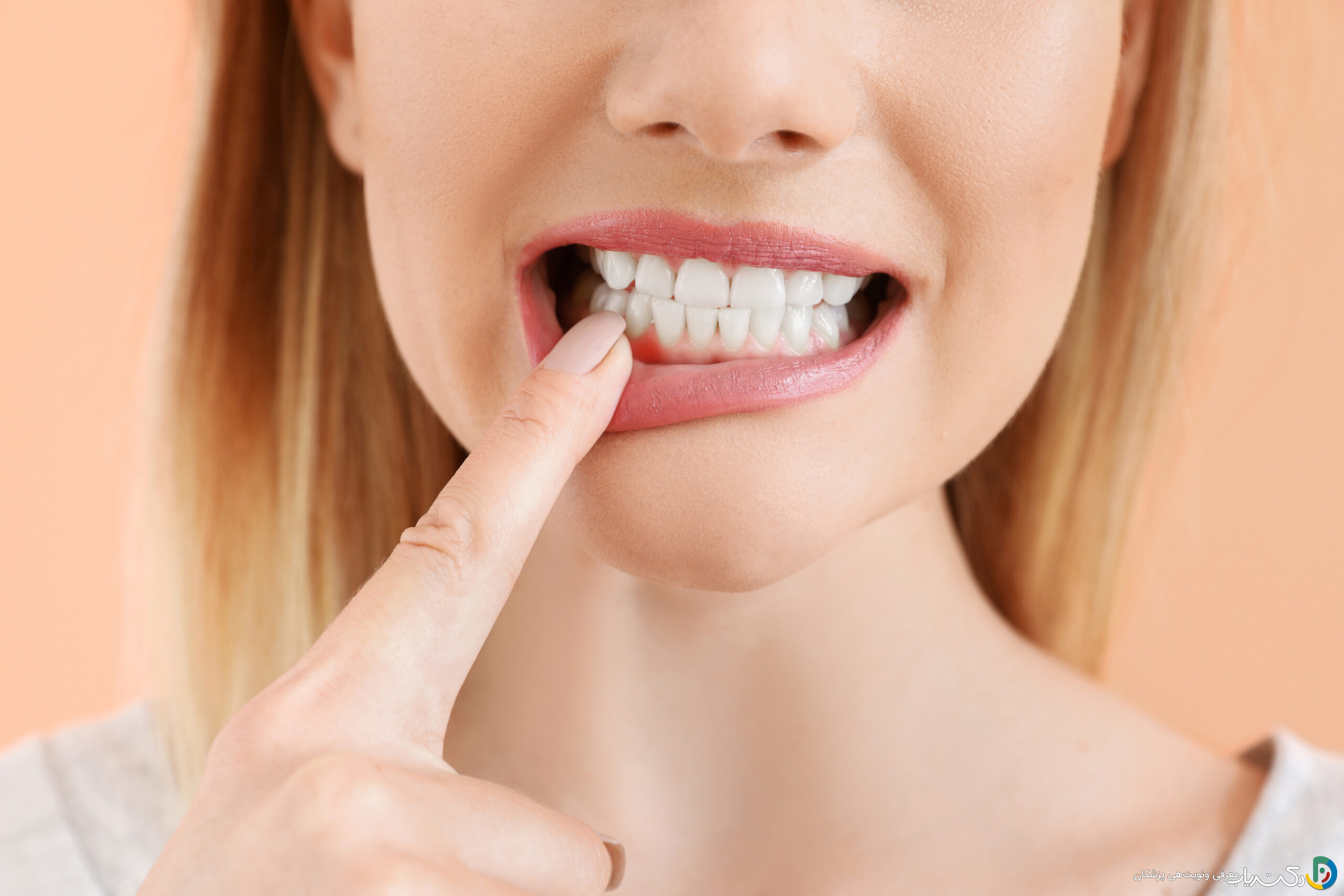 درمان سوختگی لثه با مواد بلیچینگ