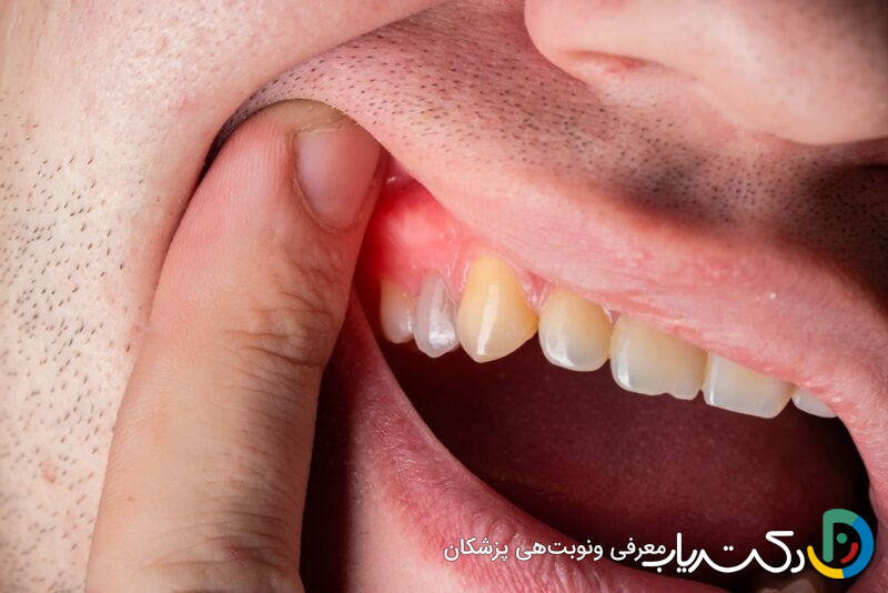 خطرات آبسه دندان چیست