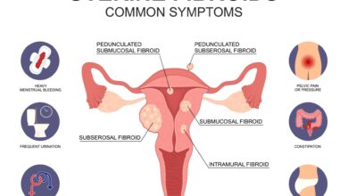 علائم داشتن فیبروم رحم چیست؟