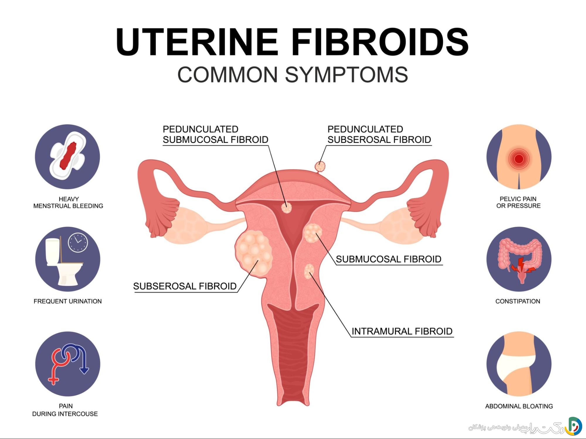 علائم داشتن فیبروم رحم چیست؟
