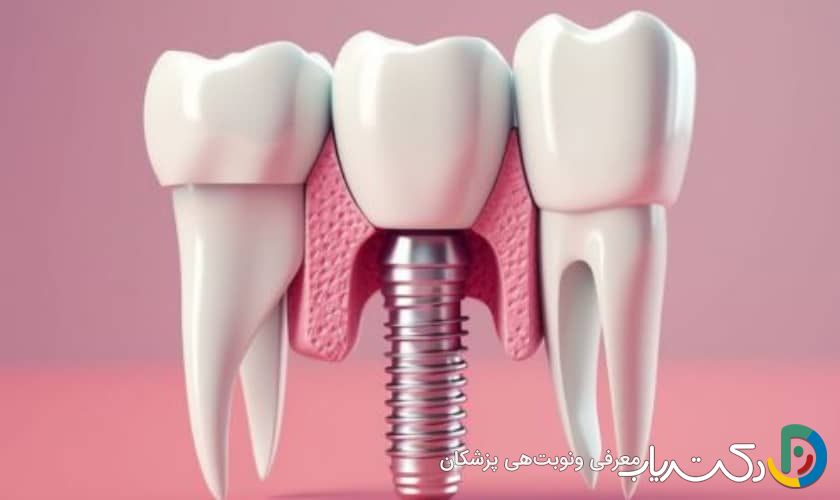 علائم آسیب به عصب بعد از جراحی ایمپلنت چیست؟