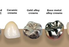 انواع روکش دندان کدامند؟