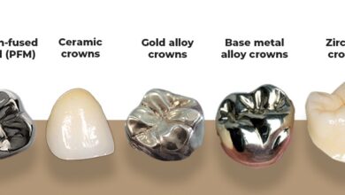 انواع روکش دندان کدامند؟