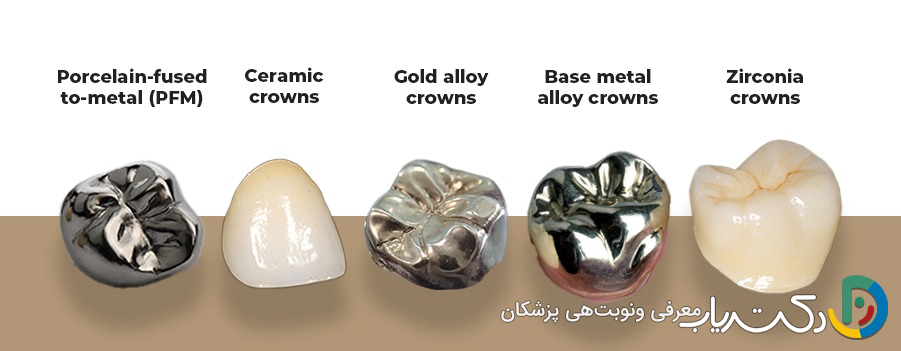 انواع روکش دندان کدامند؟