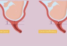علت نارسایی دهانه رحم (سرویکس) چیست؟