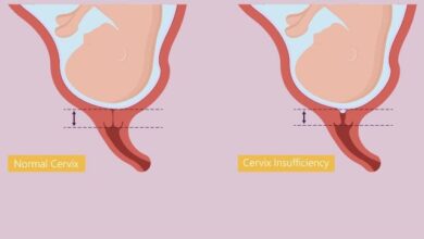 علت نارسایی دهانه رحم (سرویکس) چیست؟