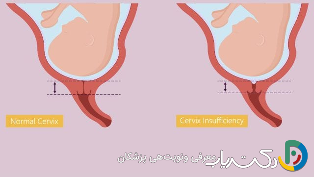 علت نارسایی دهانه رحم (سرویکس) چیست؟