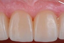 علت سیاه شدن لثه بالای روکش دندان چیست؟