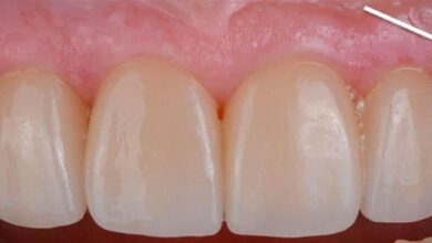 علت سیاه شدن لثه بالای روکش دندان چیست؟