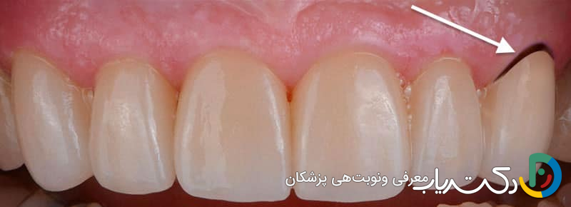 علت سیاه شدن لثه بالای روکش دندان چیست؟