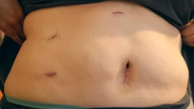 جای زخم و بخیه عمل لاپاراسکوپی چه شکلی است؟