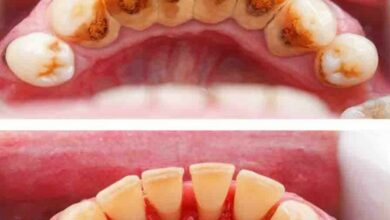 مراقبت بعد از جرم گیری دندان شامل چه مواردی می شود؟