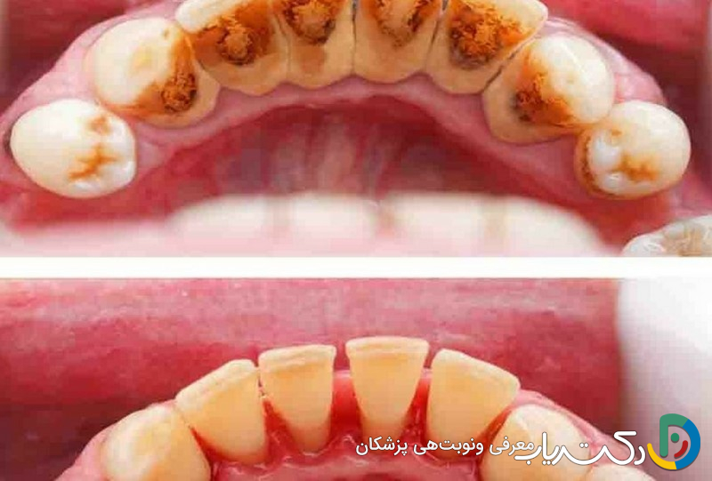 مراقبت بعد از جرم گیری دندان شامل چه مواردی می شود؟