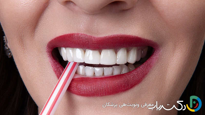 کامپوزیت IPS چیست؟ مزایای آن